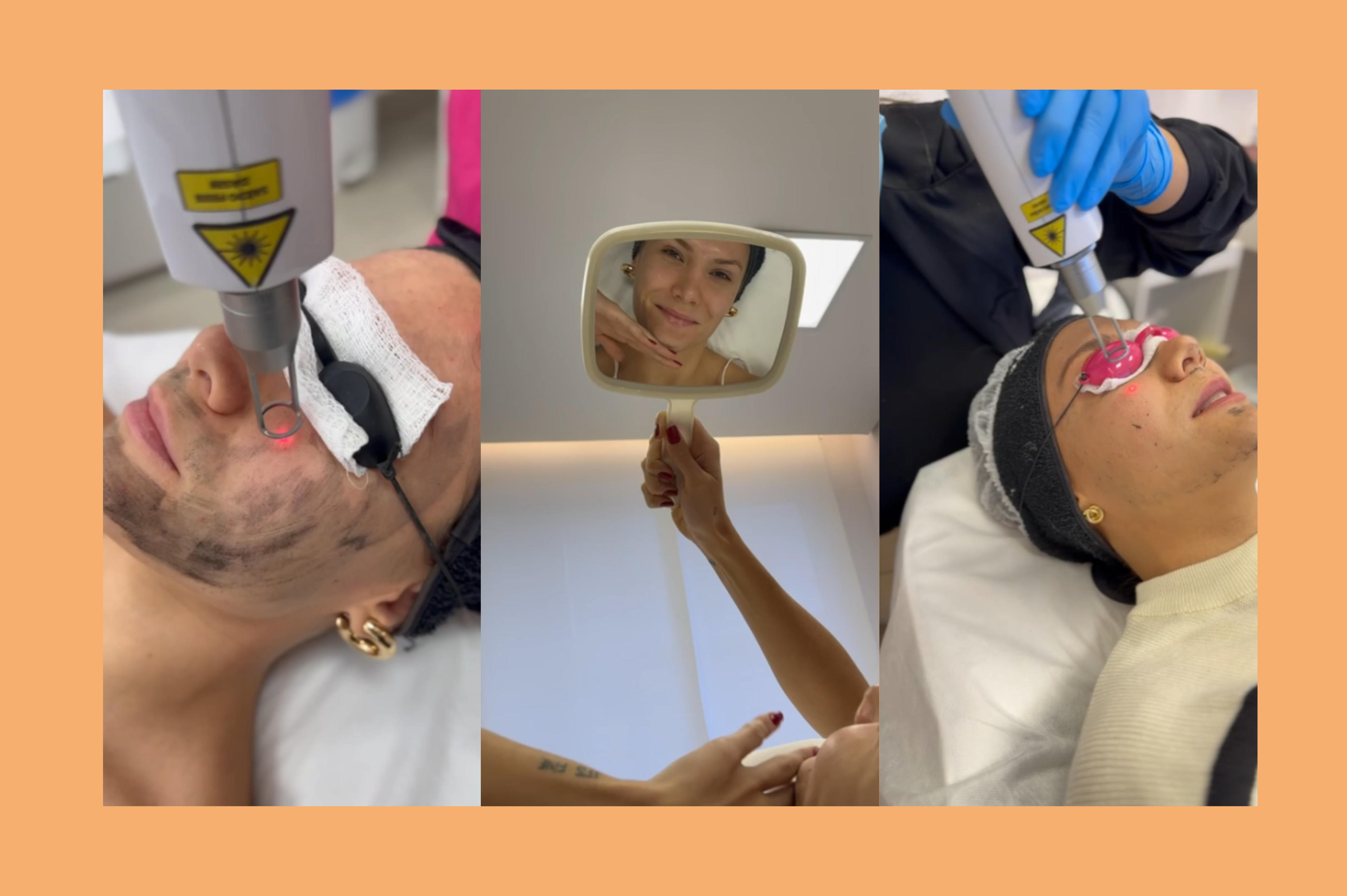 Peeling de Hollywood com Laser ND-Yag: Renovação e Brilho para a Pele